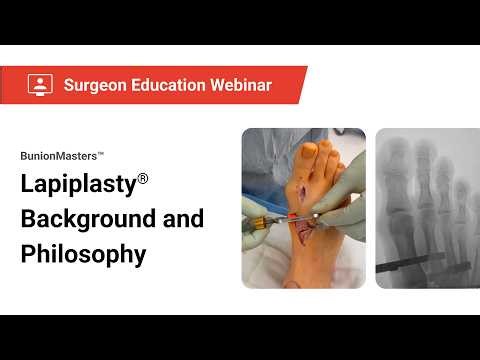 Lapiplasty Philosophy and Technique Webinar with Dr. Paul Dayton