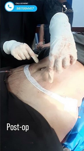 Tummy Tuck Surgery in 2023: Before And After Photos Reveal Stunning Transformation #shorts