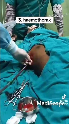 Hemothorax || water seal drainage