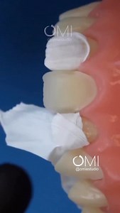 102K views · 56 reactions | Injectable Composite technique ✨ #dentist #dentistry #dentalschool | Dental Art | Facebook