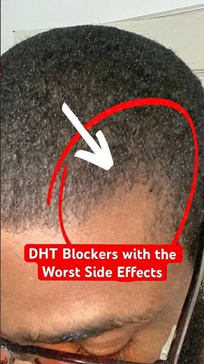 DHT Blockers! Watch out for these side effects. | Brotherly Hair Loss Tips (3/30)