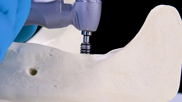 CAMLOG PROGRESSIVE-LINE Flex, Promote plus snap-in, Drilling protocol (Tap) | Handling-Tutorial