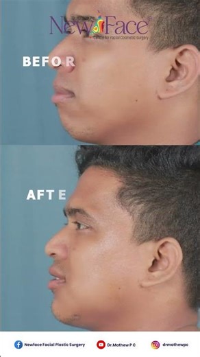 MIT Chin Surgery Explained | Minimally Invasive, Scarless & Faster Recovery