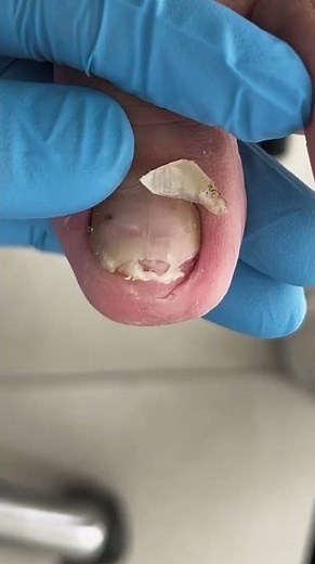 Cut off the bad nails! #pedicure