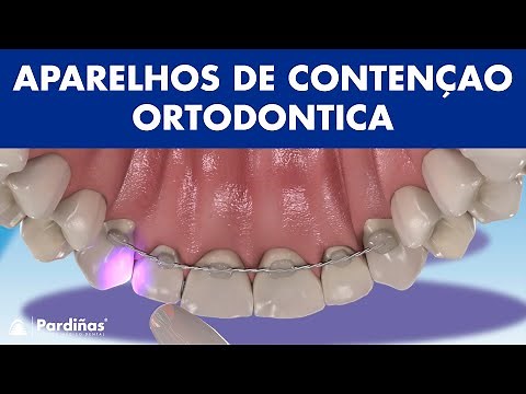 APARELHOS DE CONTENÇAO - Como evitar que os dentes se desloquem após a ortodontia ©