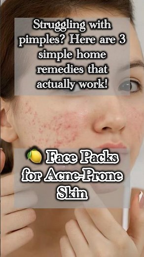 3 Easy Home Remedies to Remove Pimples Fast | Natural Skincare Tips ✨ #homeremedies