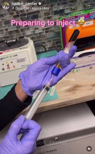 Injectable PRP Treatment Before & After Amazing results ✨ #prp #injections #antiaging