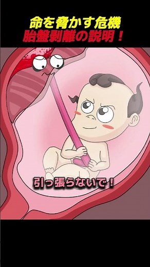 命を脅かす危機胎盤剥離の説明！