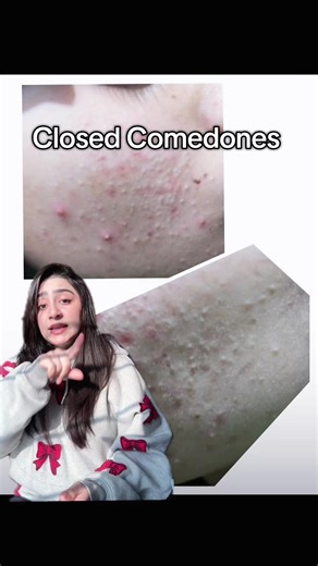 Effective Treatments for Closed Comedones
