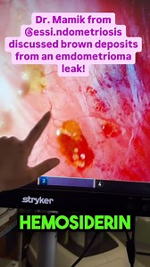 Hemosiderin is a water-insoluble, iron-containing pigment that’s usually derived from red blood cell breakdown. | Andrea Vidali MD Endometriosis, Adenomyosis , Miscarriage