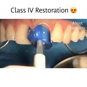 Class IV Restoration 😍😍😍 | About Dentistry