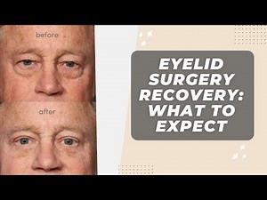 Eyelid Surgery Recovery: What To Expect