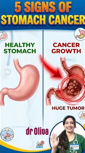 STOMACH CANCER - 5 potential signs and symptoms #shorts #health