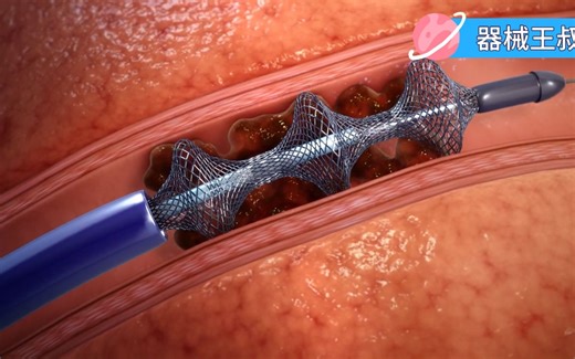 3D演示 大腿栓塞后取出栓子过程 #深静脉血栓 #DVT #血栓 #中风 #机械取栓 #微创 #医疗器械 #医生 #肺栓塞 #PE