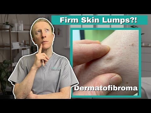 All About Dermatofibromas: Causes, Appearance, and Treatment Options