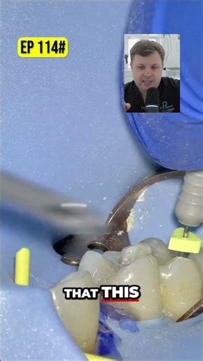 Dental DB Opening Maximize File Reach & Minimize Friction