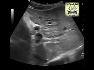 periportal cuffing liver ultrasound
