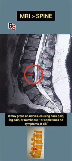 “Disc Bulge on MRI ⚠️ Don’t Ignore These Signs!” #radiology #mri #shorts