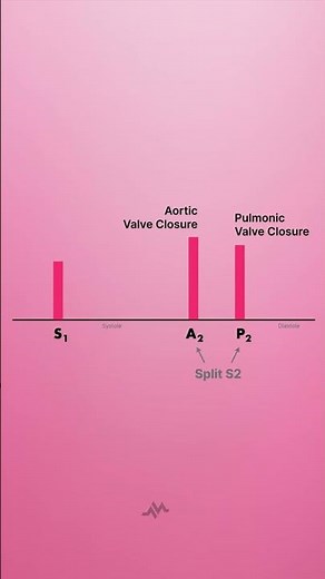 Split S2 Heart Sound - Shorts