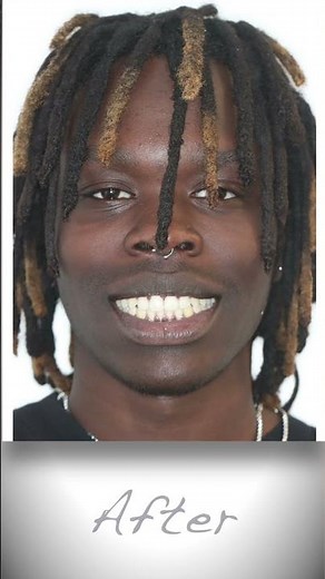 Before & After Gapped Teeth Transformation