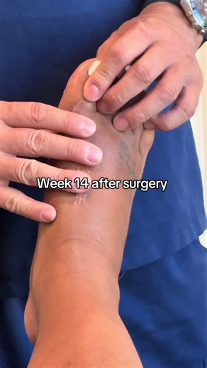 Week 14 of my bunion Surgery. I haven’t received any type of physical therapy so I took it upon myself to do it myself because I would like to have my foot back. I’m able to walk and get around. I don’t have to wear my boot all the time, but I will wear it if I have to do a client and stand up for long periods of times. I do my foot exercises at least twice a day five days out the week. The doctor cleared me to work out starting next week. Hopefully this information helps others that are going t