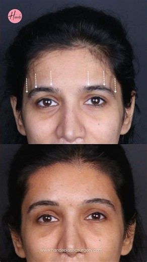 Brow Lift or Upper Eyelid Surgery? | Handa Aesthetics