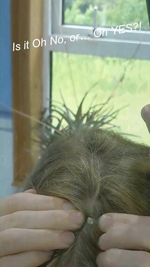 #acnetreatment #whiteheadextraction #pimplelife #pimpleremover #zitpopping #pores #pimplepopping #skincareroutine #pimplepopper #drsandralee | ONLY pimples and CYSTS popping videos