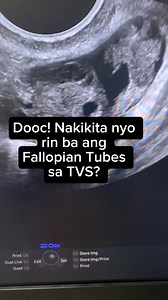 250K views · 379 reactions | We usually don’t visualize NORMAL Fallopian tubes unless may pelvic fluid like in this case. Q: How about patency? Makikita ba through ultrasound? A: Yes, via SISH! #ObGynLife #ObGynUltrasound #ObGynUltrasoundSubspecialist #GYNHealth | Snippets of OBGYN Life | Facebook