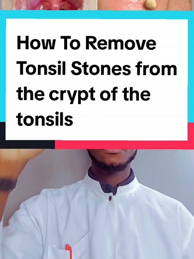 How To Remove Tonsil Stones Effectively and Safely