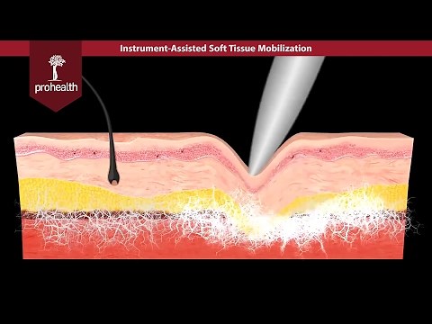 What is IASTM? - Dr. Nikita Vizniak prohealthsys.com