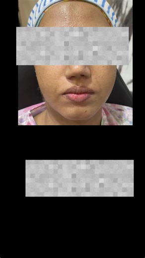 Understanding Botox and Fillers: Key Insights