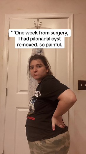 Pilonidal Cyst Surgery Experience: One Week Later