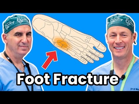 Jones and Fifth Metatarsal Fractures. How To Treat Your Broken Foot