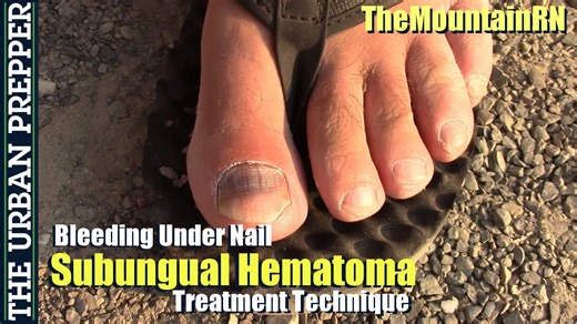 Demonstrating the blood under nail treatment technique