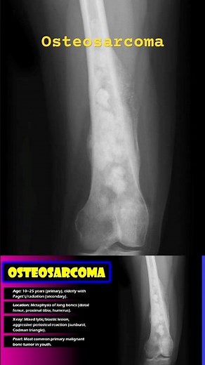 X-Ray Reveals a Deadly Bone Cancer 😱 | Osteosarcoma Explained #radiology #xray #bonecancer