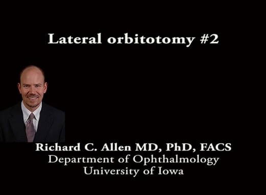 Lateral orbitotomy 2