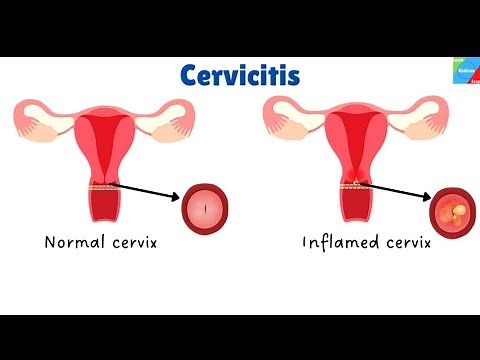 CERVICITIS- Types, Pathology, Clinical features, Diagnosis and Treatment| DC Dutta
