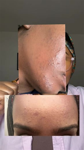 Fungal acne #somalitiktok #fyp