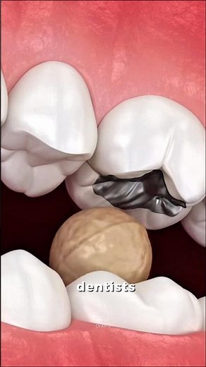 Split Tooth? Here’s How Dentists Fix It 🦷 #dentist
