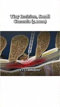 15 Minutes to Relief: The MILD Procedure for Spinal Stenosis ⏱️