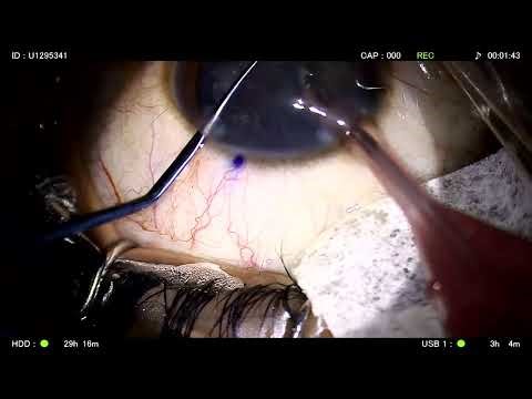 Live Cataract Surgery by Dr. Gaurav Luthra with PureSee™ Toric IOL
