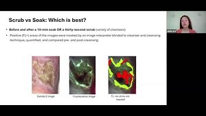 Managing Venous Leg Ulcers