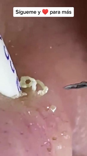 top_pimples on TikTok