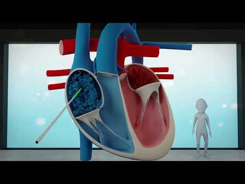 Transposition of the Great Arteries