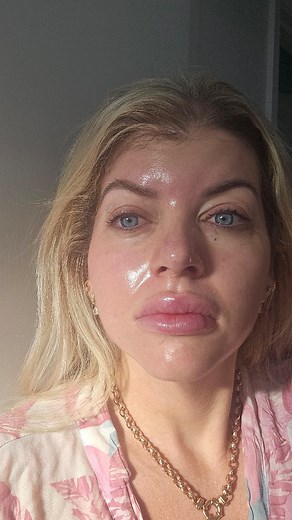 I am SO happy with my results from the Elaine Brennan Skin Renewal Peel! ✨ I filmed my whole journey and honestly… the transformation has blown me away. My skin feels smoother, brighter, tighter and completely refreshed — exactly what I needed before the busy end-of-year season. This peel is designed to deeply rejuvenate the skin, target pigmentation, fine lines, texture and dullness, and leave you with that beautifully fresh “new skin” glow. If you’ve been thinking about doing something for you