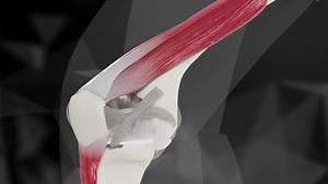 Check out this Muscle and Tendon Sparing Knee Replacement called The Jiffy Knee. NO MUSLCES OR TENDONS CUT LESS PAIN / FASTER RECOVERY Call 708-237-7200 to make an Appt with Dr. Sarkis Bedikian or https://jiffyknee.com/doctors/dr-sarkis-m-bedikian/ Dr. Bedikian is the ONLY total knee Surgeon in Illinois that performs The Jiffy Knee Replacement. A Mini-Mid Vastus is not the same!! A mid-vastus approach still cuts the mid- portion of the muscle!! HIT LIKE AND SHARE !!! Visit www.Jiffyknee.com for 