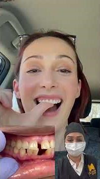 FLIPPERS,Partial DENTURE #oralhealth #viral #dentist #smile #youtubeshorts #shorts #dentures #fyp #f