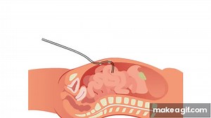 Peritoneal Dialysis... explained on Make a GIF