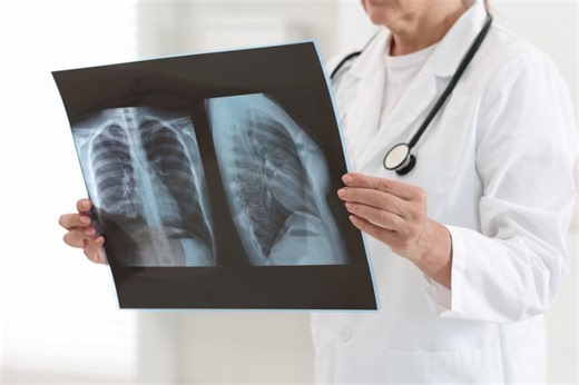 Adénocarcinome pulmonaire : la survie à 3 ans a doublé depuis 2000