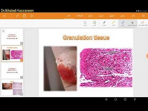 Granulation tissue (1st step of repair)